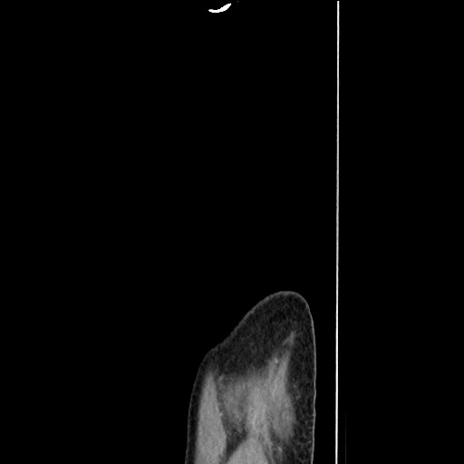 Closed loop small bowel obstruction - omental adhesion causing "internal hernia" (Radiopaedia 85129-100682 C 180).jpg