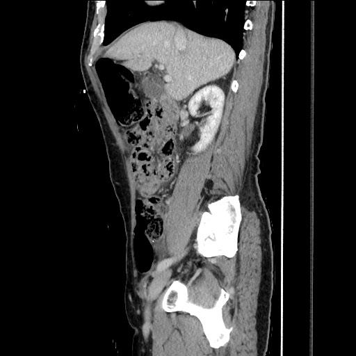 Closed loop small bowel obstruction - omental adhesion causing "internal hernia" (Radiopaedia 85129-100682 C 69).jpg