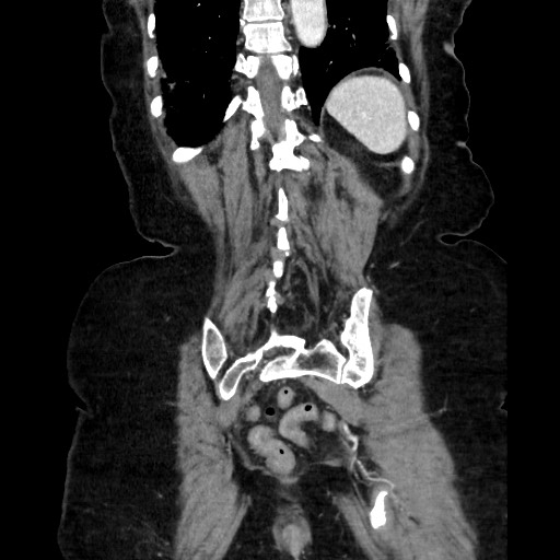 Closed loop small bowel obstruction due to adhesive band, with intramural hemorrhage and ischemia (Radiopaedia 83831-99017 C 101).jpg