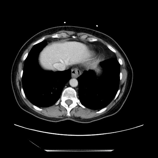 File:Closed loop small bowel obstruction due to adhesive bands - early and late images (Radiopaedia 83830-99014 A 12).jpg