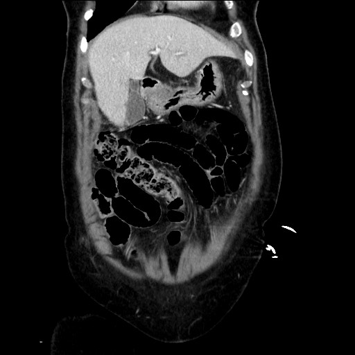 Closed loop small bowel obstruction due to adhesive bands - early and late images (Radiopaedia 83830-99014 B 36).jpg