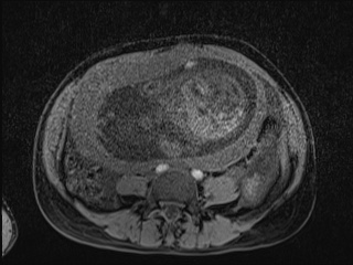Closed loop small bowel obstruction in pregnancy (MRI) (Radiopaedia 87637-104031 F 20).jpg