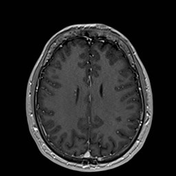 File:Cochlear incomplete partition type III associated with hypothalamic hamartoma (Radiopaedia 88756-105498 Axial T1 C+ 130).jpg