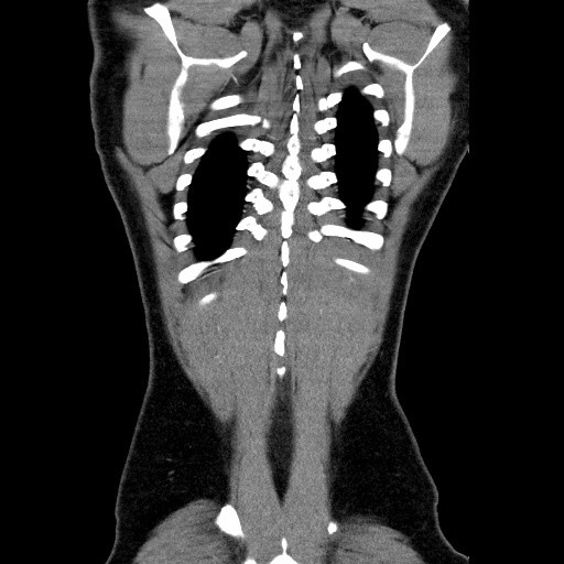 File:Codominant double aortic arch (Radiopaedia 56012-62637 B 44).jpg