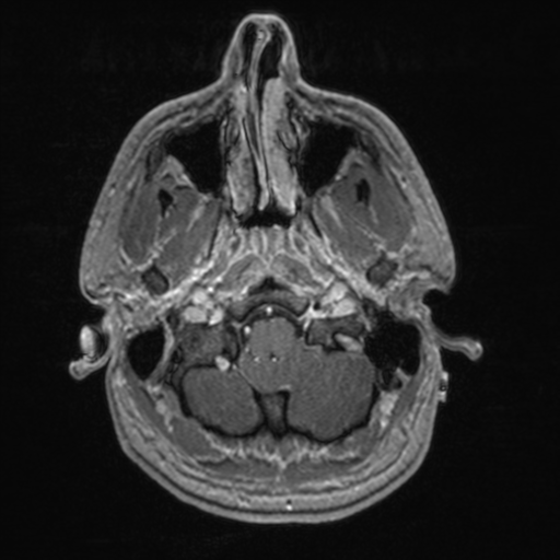File:Colloid cyst (Radiopaedia 44510-48181 Axial T1 C+ 34).png