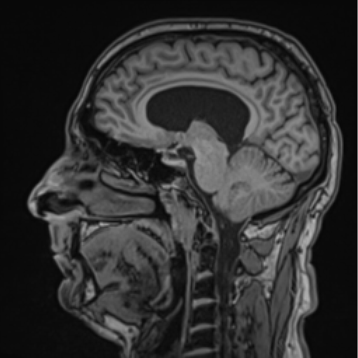 File:Colloid cyst of the third ventricle (Radiopaedia 86571-102662 Sagittal T1 43).png