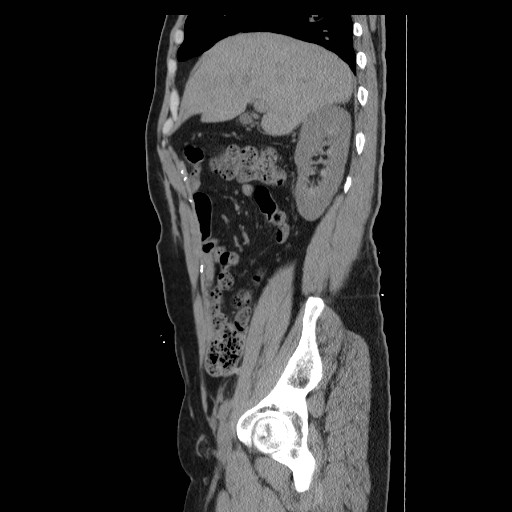 File:Colocutaneous fistula in Crohn's disease (Radiopaedia 29586-30093 C 6).jpg