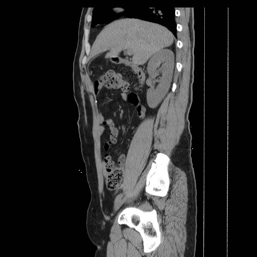 File:Colocutaneous fistula in Crohn's disease (Radiopaedia 29586-30093 C 9).jpg