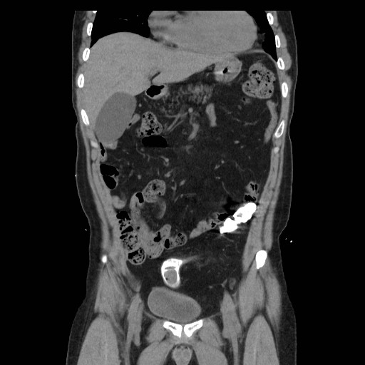 File:Colocutaneous fistula in Crohn's disease (Radiopaedia 29586-30093 E 9).jpg