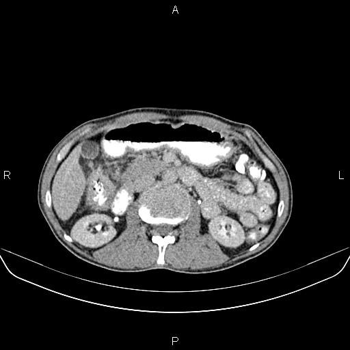 File:Colon adenocarcinoma - hepatic flexure (Radiopaedia 85635-101395 Axial C+ delayed 37).jpg