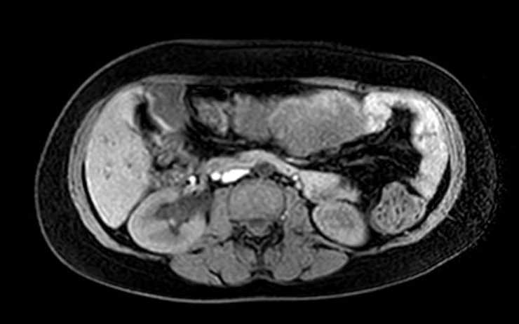 File:Colon adenocarcinoma with Krukenberg tumors, advanced pregnancy (Radiopaedia 67279-76645 A 49).jpg