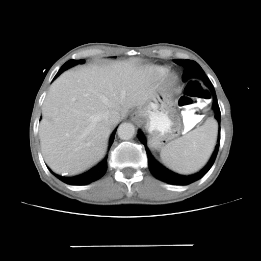 Colon cancer with calcified liver metastasis (Radiopaedia 74423-85307 A 14).jpg