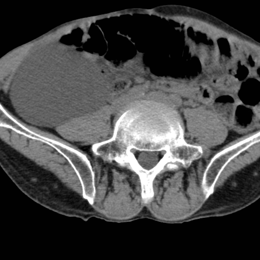 File:Colon cancer with calcified liver metastasis (Radiopaedia 74423-85309 Axial non-contrast 71).jpg