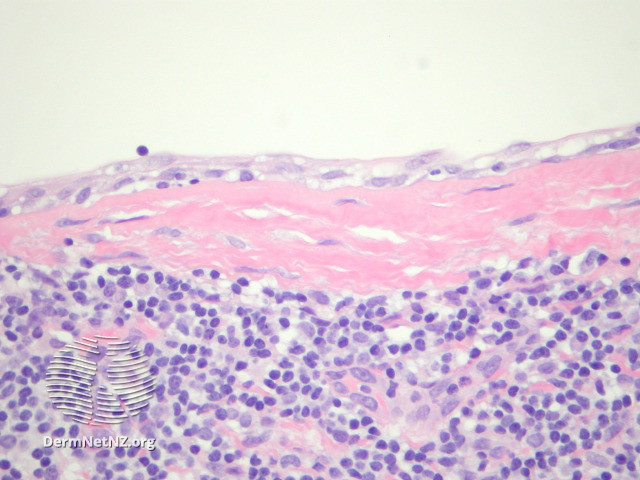 File:Figure 3 (DermNet NZ pathology-e-branchial-cleft-cyst-figure-3).jpg