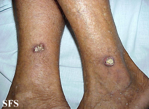 File:Keratoacanthoma (Dermatology Atlas 23).jpg