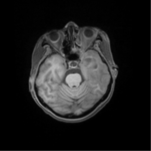 File:Nasopharyngeal carcinoma with cerebral abscess (Radiopaedia 43018-46274 Axial T1 fat sat 19).png
