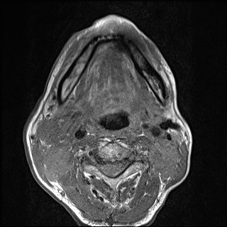 File:Nasopharyngeal carcinoma with skull base invasion (Radiopaedia 59258-66600 B 40).jpg