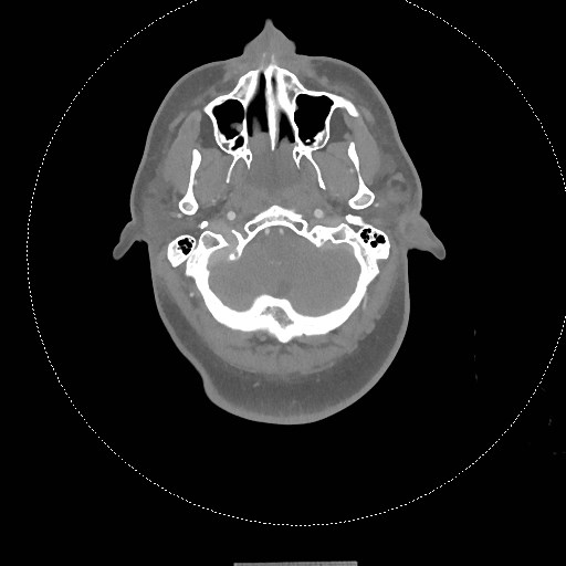 Neck CT angiogram (intraosseous vascular access) (Radiopaedia 55481-61945 B 253).jpg
