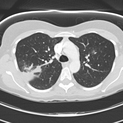 Necrobiotic pulmonary nodules - Crohn disease (Radiopaedia 20723-20631 Axial lung window 47).jpg