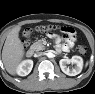 File:Necrotizing pancreatitis with acute necrotic collection (Radiopaedia 14470-14417 B 15).jpg