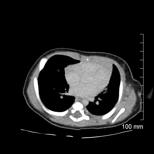 File:Neonatal neuroblastoma (Radiopaedia 56651-63438 Axial non-contrast 3).jpg
