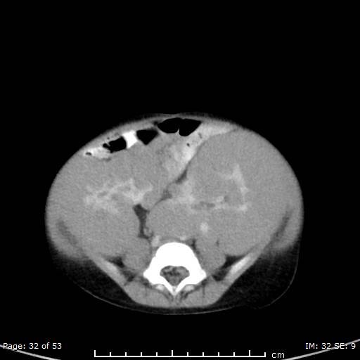 File:Nephroblastomatosis (Radiopaedia 41934-44935 A 32).jpg