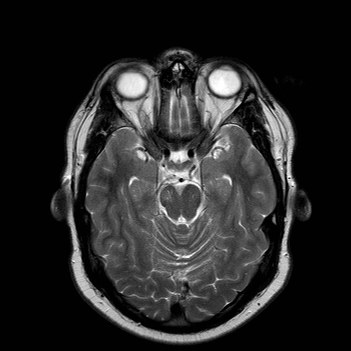 File:Neuro-Behcet's disease (Radiopaedia 21557-21505 Axial T2 8).jpg