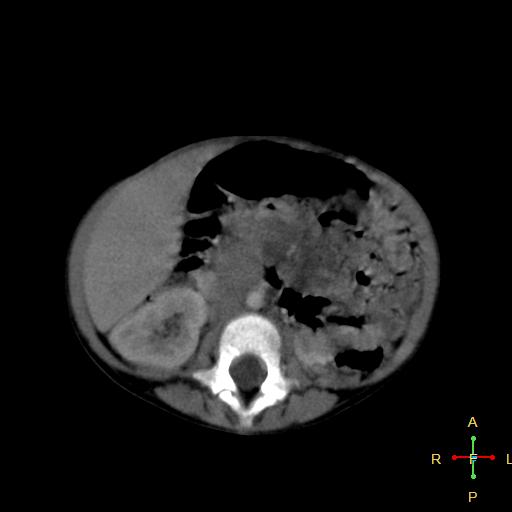 File:Neuroblastoma (Radiopaedia 24751-25016 D 22).jpg