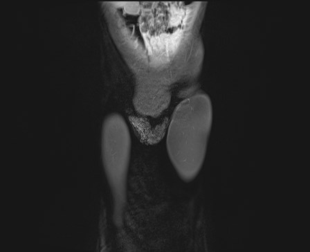 File:Neuroblastoma with bone metastases (Radiopaedia 67080-76414 E 1).jpg
