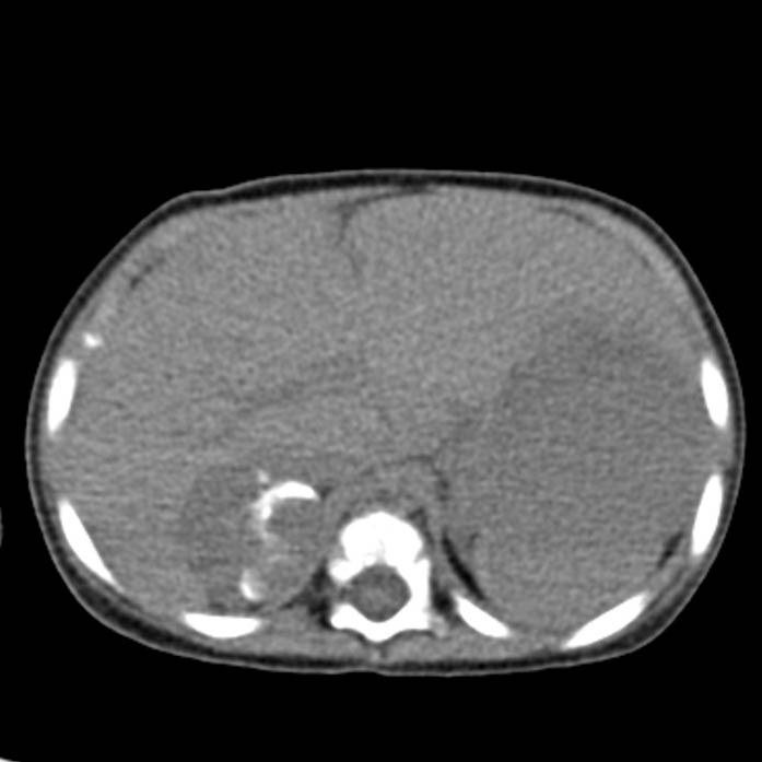 Neuroblastoma with skull metastases (Radiopaedia 30326-30960 Axial non-contrast 14).jpg
