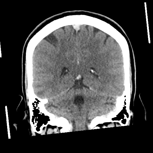 Neurocysticercosis - granular nodular (Radiopaedia 42786-45957 Coronal C+ 44).png