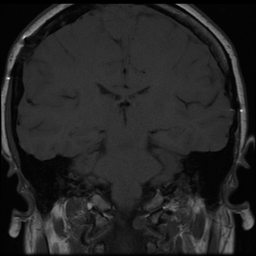 File:Neurofibromatosis type 2 (Radiopaedia 45229-49251 Coronal T1 5).png