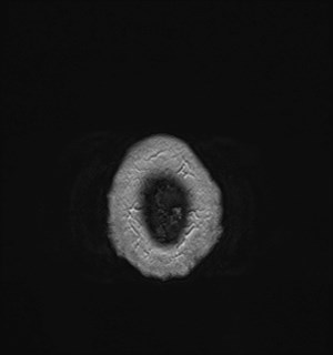 Neurofibromatosis type 2 (Radiopaedia 79097-92049 Axial T1 C+ 188).jpg