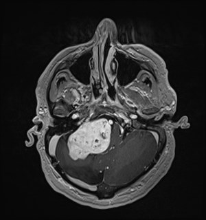Neurofibromatosis type 2 (Radiopaedia 79097-92049 Axial T1 C+ 50).jpg