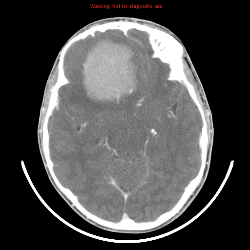 File:Neurofibromatosis type 2 (Radiopaedia 8953-9732 C 15).jpg