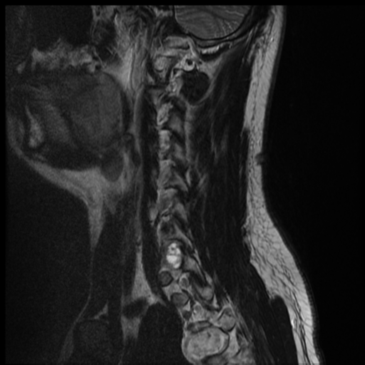 File:Neurofibromatosis type 2 (spinal manifestations) (Radiopaedia 53943-60070 Sagittal T2 12).png