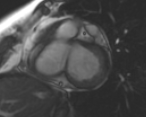File:Non-compaction of the left ventricle (Radiopaedia 69436-79314 Short axis cine 168).jpg