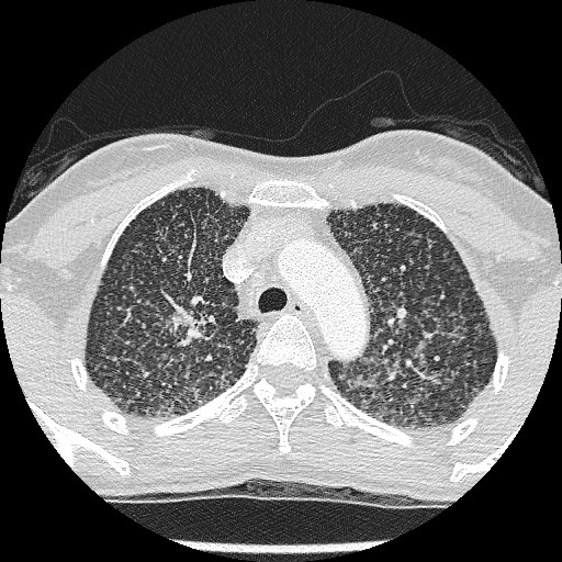 File:Non-small cell lung cancer with miliary metastases (Radiopaedia 23995-24193 Axial lung window 8).jpg