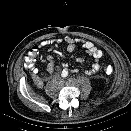 File:Non Hodgkin lymphoma in a patient with ankylosing spondylitis (Radiopaedia 84323-99621 Axial non-contrast 45).jpg