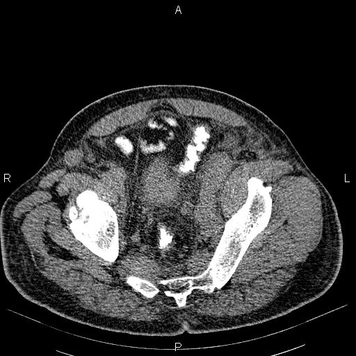 File:Non Hodgkin lymphoma in a patient with ankylosing spondylitis (Radiopaedia 84323-99621 Axial non-contrast 55).jpg