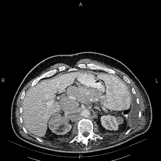 File:Non Hodgkin lymphoma in a patient with ankylosing spondylitis (Radiopaedia 84323-99621 B 33).jpg