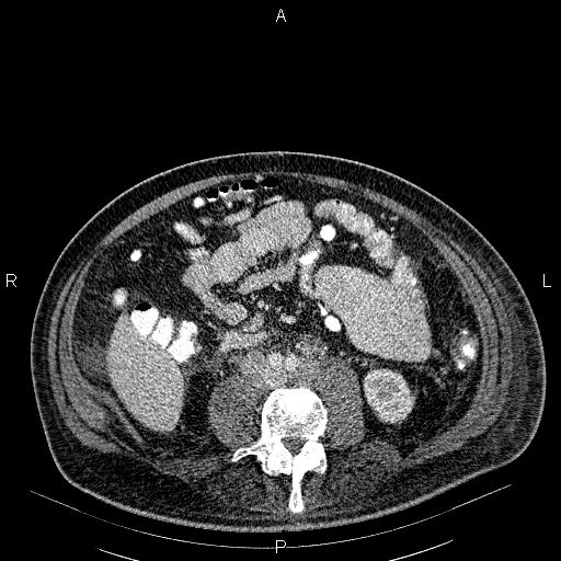 File:Non Hodgkin lymphoma in a patient with ankylosing spondylitis (Radiopaedia 84323-99621 B 44).jpg