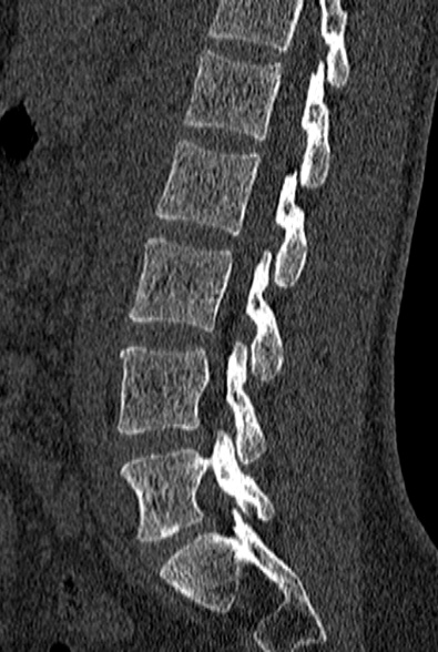 File:Normal CT lumbar spine (Radiopaedia 53981-60118 Sagittal bone window 59).jpg