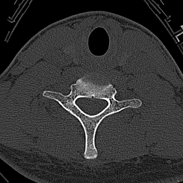 Normal CT of the cervical spine (Radiopaedia 53322-59305 Axial bone window 202).jpg