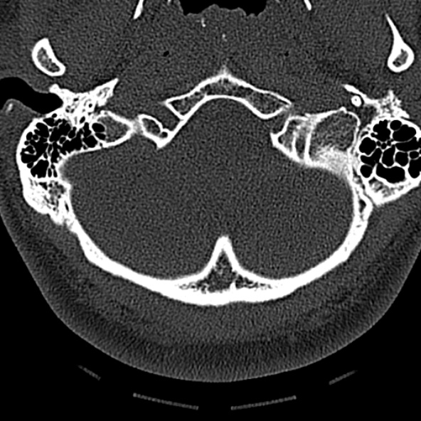 File:Normal CT of the cervical spine (Radiopaedia 53322-59305 Axial bone window 30).jpg