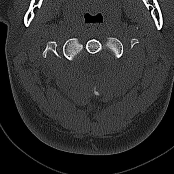File:Normal CT of the cervical spine (Radiopaedia 53322-59305 Axial bone window 68).jpg