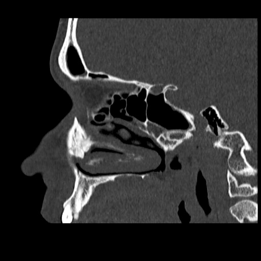 Normal CT paranasal sinuses (Radiopaedia 42286-45390 Sagittal bone window 64).jpg