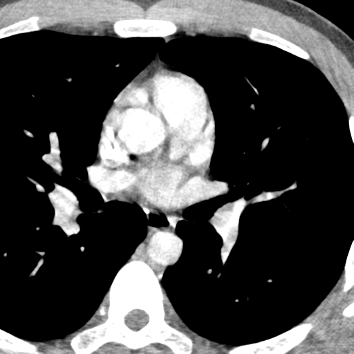 File:Normal CT pulmonary veins (pre RF ablation) (Radiopaedia 41748-44702 A 109).png