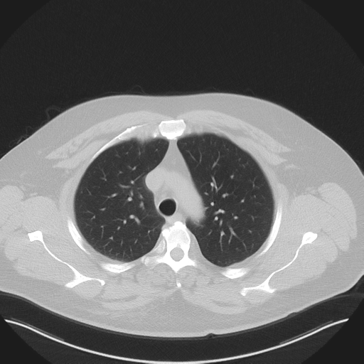 Normal HRCT (Radiopaedia 40797-43458 Axial lung window 16).png