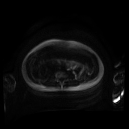 Normal MRI abdomen in pregnancy (Radiopaedia 88001-104541 Axial DWI 111).jpg
